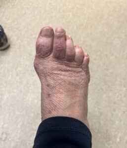 After Image: Minmally invasive crossover toe correction