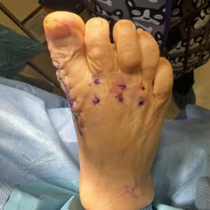 After Image: Great toe fusion with hammertoe correction