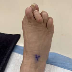 Before Image: Great toe fusion with hammertoe correction