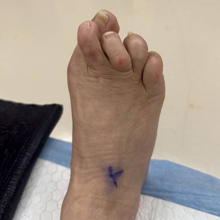 Before Image: Great toe fusion with hammertoe correction - front