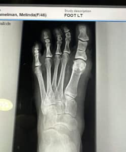 After Image: Minimally invasive bunion and crooked 4th toe correction