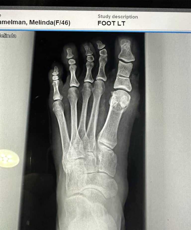 After Image: Minimally invasive bunion and crooked 4th toe correction - front