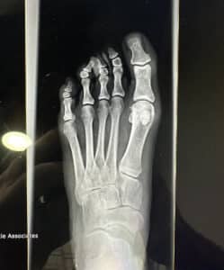 Before Image: Minimally invasive bunion and crooked 4th toe correction