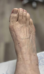 After Image: Minimally Invasive Bunionectomy