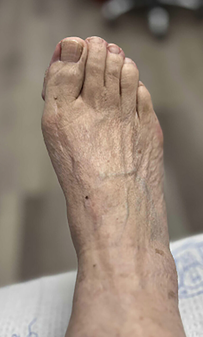 After Image: Minimally Invasive Bunionectomy - front