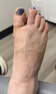 Before Image: Minimally Invasive Bunionectomy