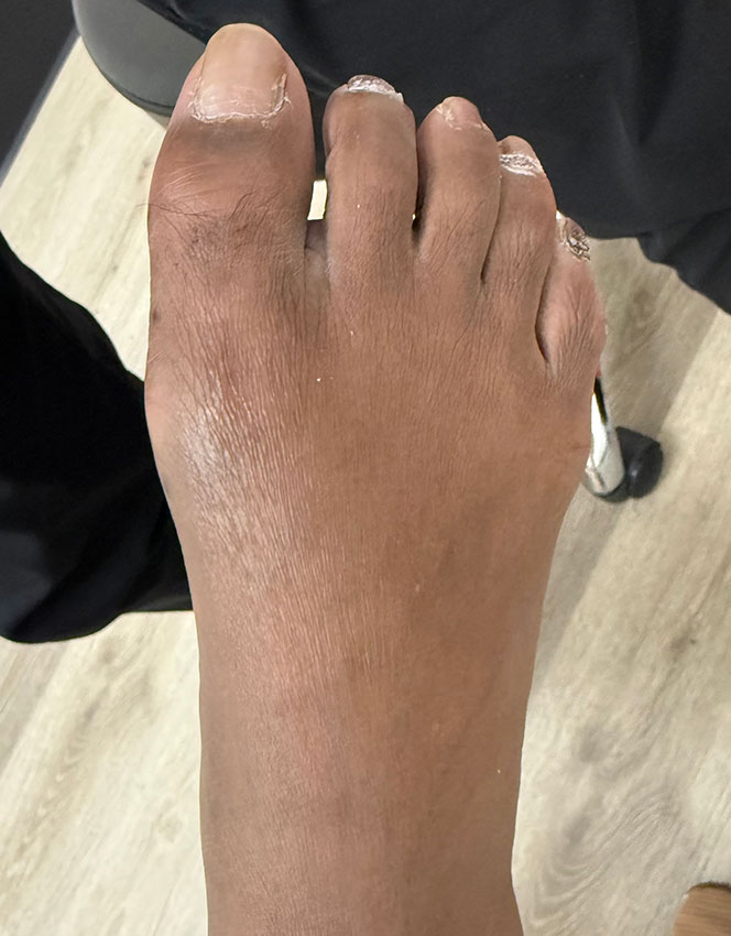 After Image: Minimally Invasive Bunionectomy - front