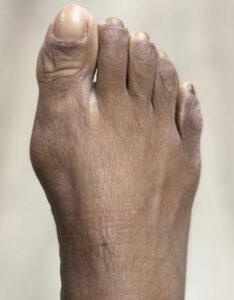 Before Image: Minimally Invasive Bunionectomy